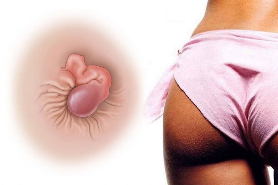 La crème naturelle guérit les hémorroïdes dans un cours